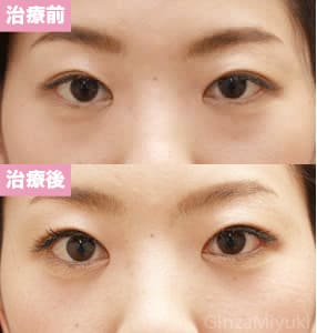 モニター症例№60（28歳 女性）脱脂リポ法