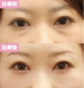 モニター症例№61（35歳 女性）脱脂ダブルリポ