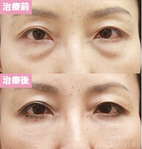 モニター症例№63（48歳 女性）脱脂ダブルリポ