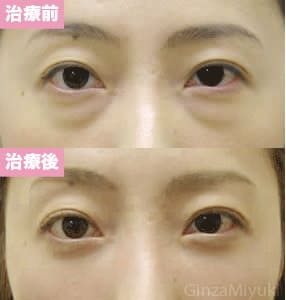 モニター症例№65（34歳 女性）脱脂ダブルリポ