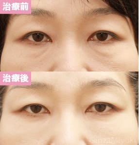 モニター症例№66（47歳 女性）脱脂コンデンスリポ