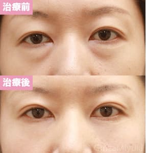 モニター症例№67（42歳 女性）脱脂コンデンスリポ