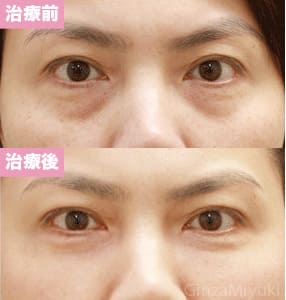 モニター症例№69（40歳 女性）脱脂コンデンスリポ