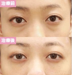 モニター症例№70（29歳 女性）脱脂ダブルリポ