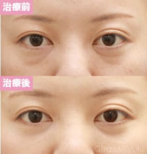 モニター症例№71（26歳 女性）脱脂コンデンスリポ