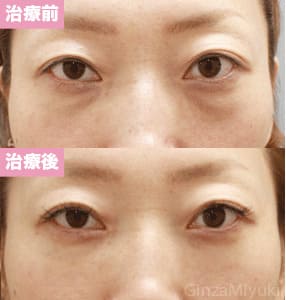 モニター症例№72（40歳 女性）脱脂コンデンスリポ