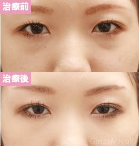 モニター症例№73（24歳 女性）脱脂コンデンスリポ