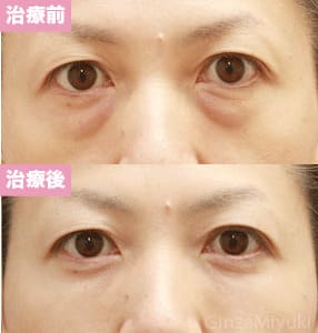 モニター症例№74（47歳 女性）脱脂コンデンスリポ