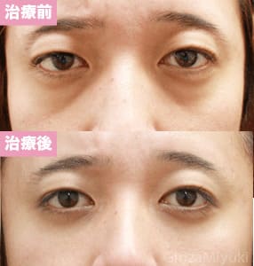 モニター症例№75（37歳 男性）脱脂コンデンスリポ