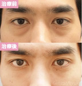 モニター症例№76（32歳 男性）脱脂ダブルリポ