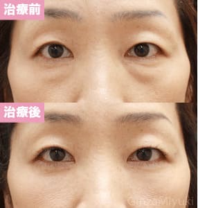 モニター症例№77（44歳 女性）脱脂コンデンスリポ