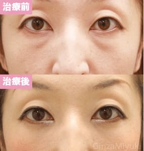 モニター症例№78（32歳 女性）脱脂コンデンスリポ