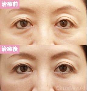 モニター症例№79（48歳 女性）脱脂コンデンスリポ