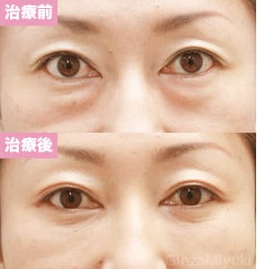 モニター症例№80（39歳 女性）脱脂コンデンスリポ