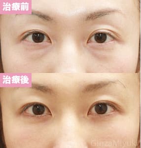 モニター症例№81（29歳 女性）脱脂コンデンスリポ