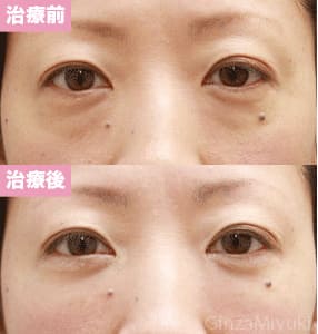 モニター症例№83（40歳 女性）脱脂コンデンスリポ