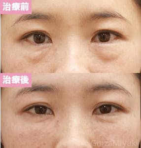 モニター症例№86（38歳 女性）脱脂コンデンスリポ