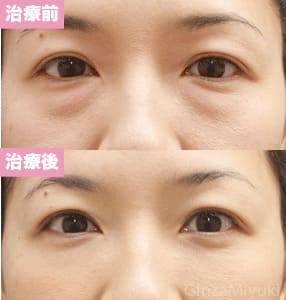 モニター症例№88（36歳 女性）脱脂コンデンスリポ