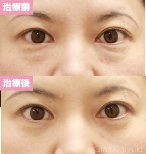 モニター症例№90（41歳 女性）脱脂ダブルリポ