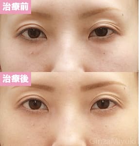 モニター症例№92（32歳 女性）脱脂コンデンスリポ