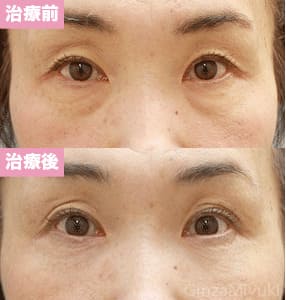 モニター症例№93（53歳 女性）脱脂コンデンスリポ