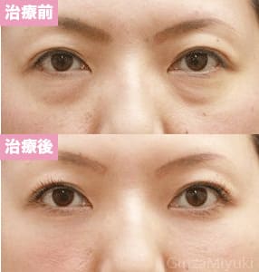 モニター症例№94（41歳 女性）脱脂コンデンスリポ