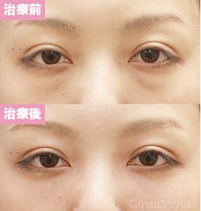 モニター症例№95（29歳 女性）脱脂コンデンスリポ