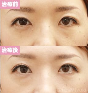 モニター症例№96（34歳 女性）経結膜脱脂