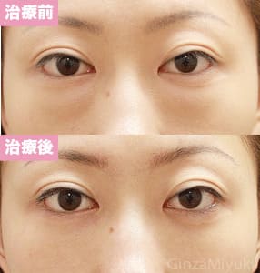 モニター症例№97（28歳 女性）脱脂コンデンスリポ