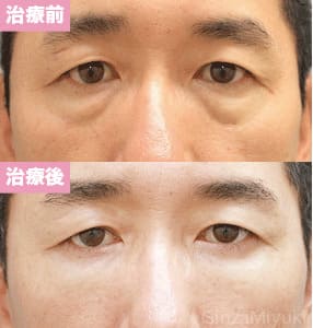 モニター症例№98（45歳 男性）脱脂コンデンスリポ