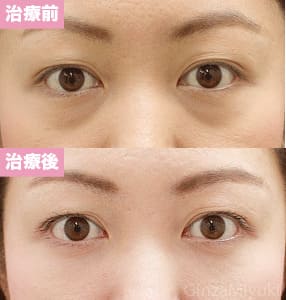 モニター症例№99（29歳 女性）脱脂コンデンスリポ