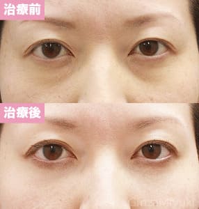 モニター症例№100（32歳 女性）脱脂コンデンスリポ