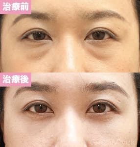 モニター症例№102（38歳 女性）脱脂コンデンスリポ