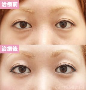 モニター症例№103（27歳 女性）脱脂コンデンスリポ