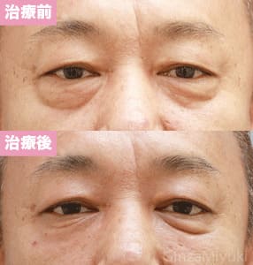 モニター症例№104（51歳 男性）脱脂コンデンスリポ