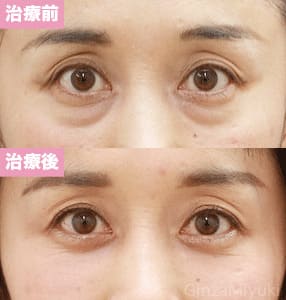 モニター症例№106（45歳 女性）脱脂コンデンスリポ