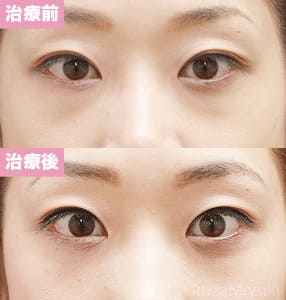 モニター症例№107（32歳 女性）脱脂コンデンスリポ