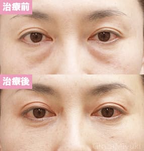 モニター症例№108（46歳 女性）脱脂コンデンスリポ