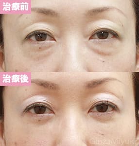 モニター症例№109（52歳 女性）脱脂コンデンスリポ