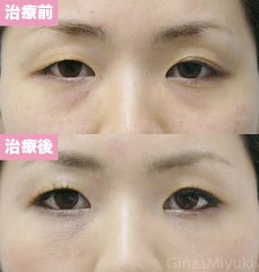 モニター症例№111（32歳 女性）脱脂ダブルリポ