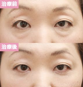 モニター症例№112（43歳 女性）脱脂コンデンスリポ