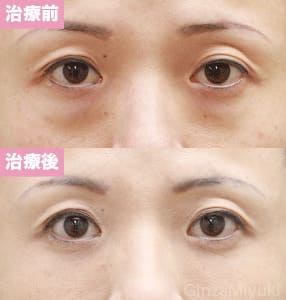 モニター症例№113（39歳 女性）脱脂コンデンスリポ