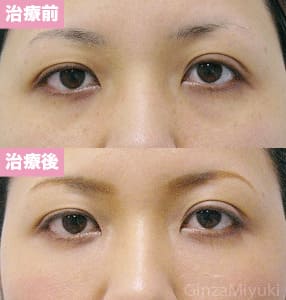 モニター症例№114（29歳 女性）脱脂ダブルリポ