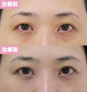 モニター症例№115（33歳 女性）脱脂ダブルリポ