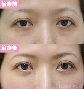 モニター症例№116（41歳 女性）脱脂ダブルリポ