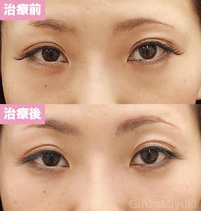 モニター症例№117（31歳 女性）脱脂コンデンスリポ