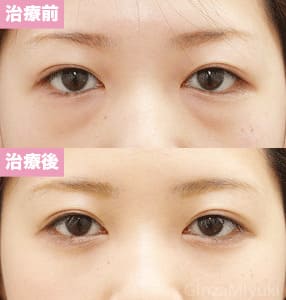 モニター症例№118（26歳 女性）脱脂コンデンスリポ