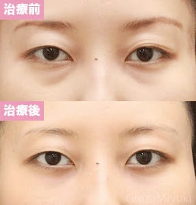 モニター症例№119（26歳 女性）脱脂コンデンスリポ