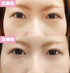 モニター症例№120（23歳 女性）脱脂コンデンスリポ