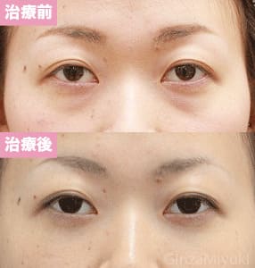 モニター症例№121（25歳 女性）脱脂コンデンスリポ